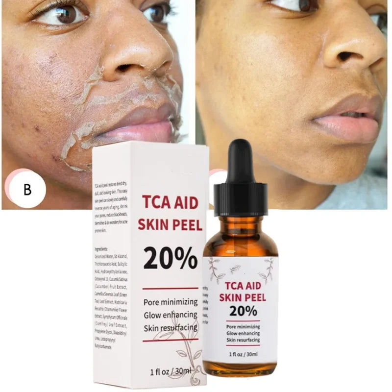 30ml bottle of 20% TCA skin peel solution for pore minimizing and age spot treatment
