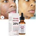 30ml bottle of 20% TCA skin peel solution for pore minimizing and age spot treatment