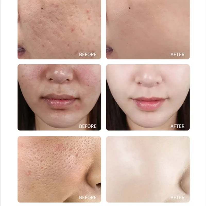 30ml bottle of 20% TCA skin peel solution for pore minimizing and age spot treatment — view 2