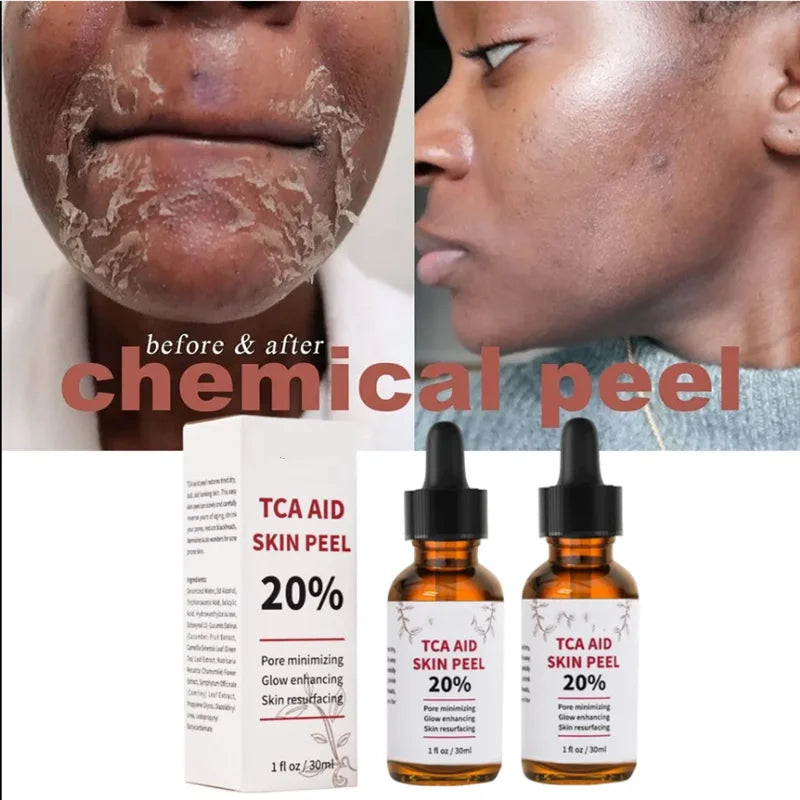 30ml bottle of 20% TCA skin peel solution for pore minimizing and age spot treatment — view 4